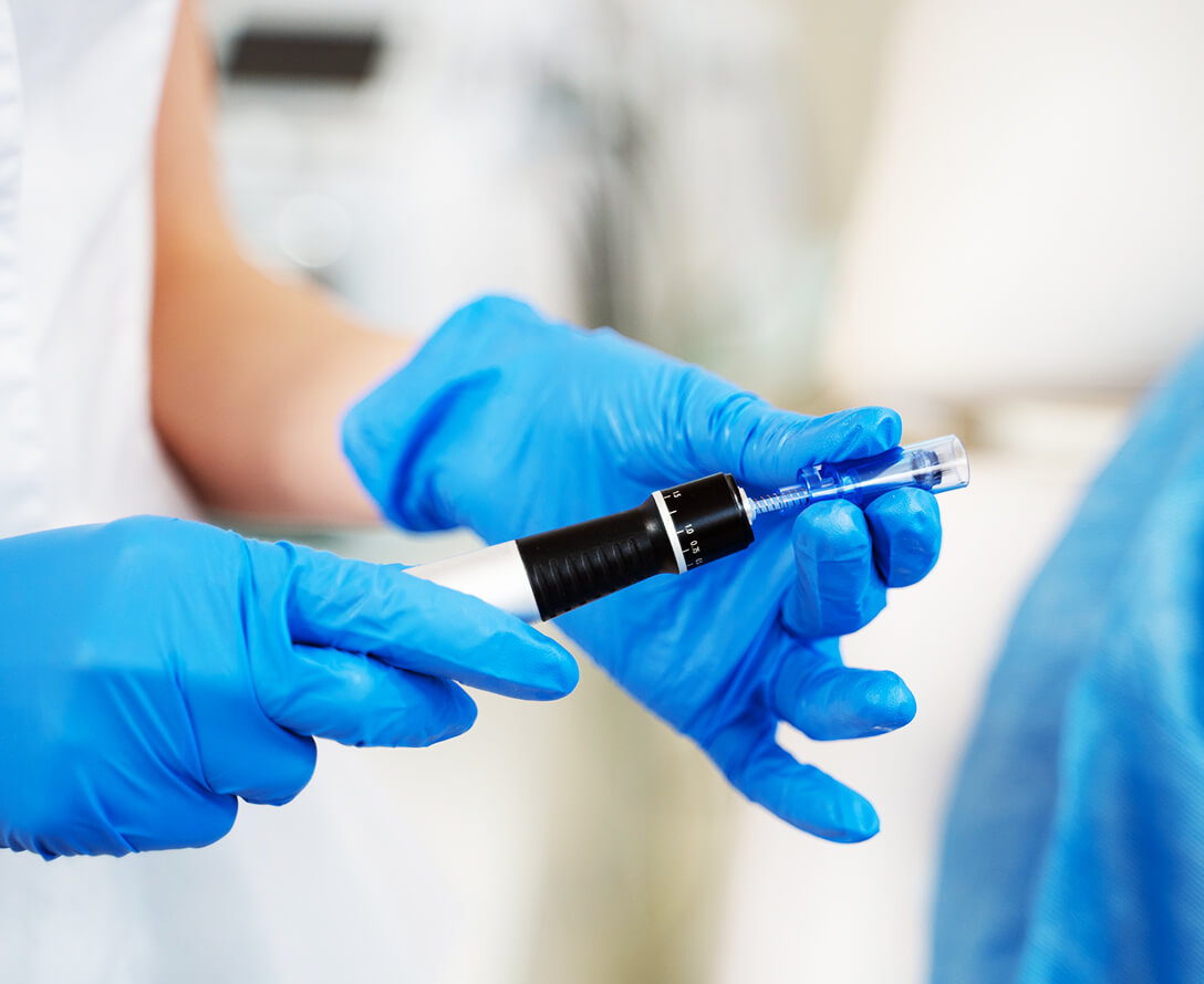 Does Microneedling Help Reduce Acne? | EverYoung Skin Clinic