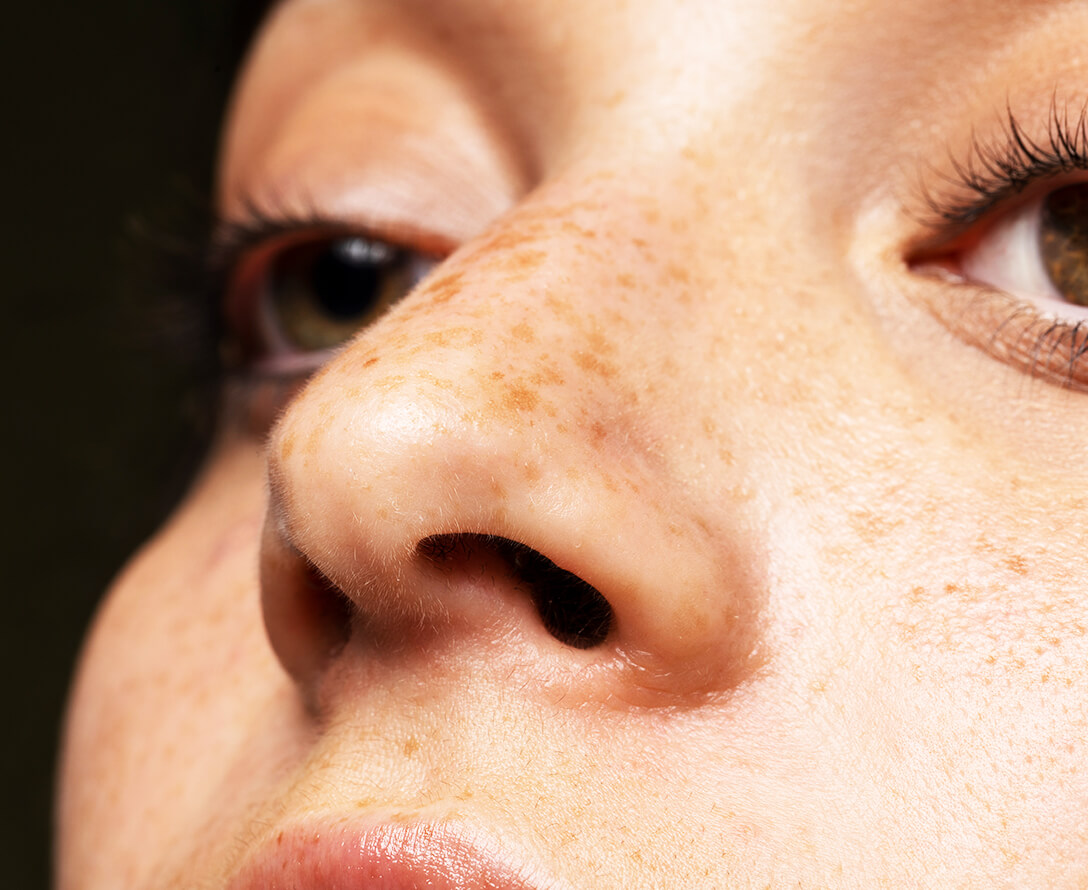 Sunspots vs. Freckles: What’s the Difference? | EverYoung Skin Clinic