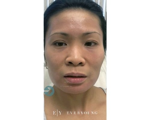 1 Everyoung-medical-aesthetics-jawline-slimming-After-vancouver-medispa (2)