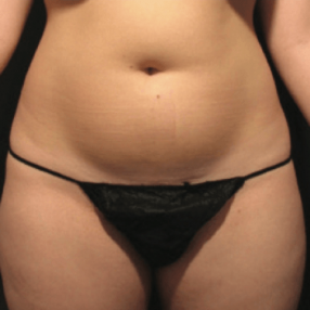 1-velashape-before-after-EverYoung-Medical-Aesthetics-cellulite-fat-loss-Vancouver-Port-Coquitlam