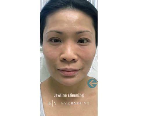 2 Everyoung-medical-aesthetics-jawline-slimming-After-vancouver-medispa