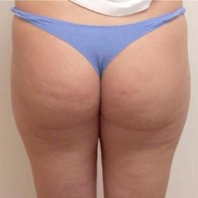 VelaShape Treatments Vancouver, Burnaby & Coquitlam 1 3-velashape-before-and-after-butt-velashape-before-after-EverYoung-Medical-Aesthetics-cellulite-fat-loss-Vancouver-Port-Coquitlam
