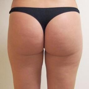VelaShape Treatments Vancouver, Burnaby & Coquitlam 2 4-velashape-before-and-after-butt-velashape-before-after-EverYoung-Medical-Aesthetics-cellulite-fat-loss-Vancouver-Port-Coquitlam
