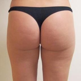 Cellulite Reduction - Coquitlam Medical Laser