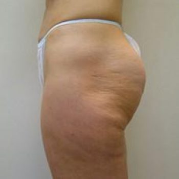 5-velashape-before-and-after-cellulite-EverYoung-Medical-Aesthetics-Port-Coquitlam-BC