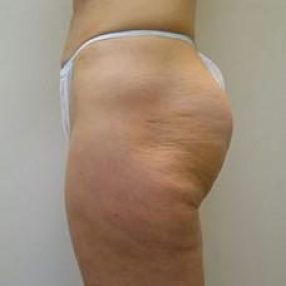 Cellulite Reduction - Coquitlam Medical Laser