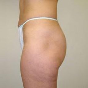 VelaShape Treatments Vancouver, Burnaby & Coquitlam 4 6-velashape-before-and-after-cellulite-EverYoung-Port-Coquitlam-Medspa