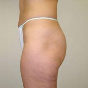 Cellulite Reduction - Coquitlam Medical Laser