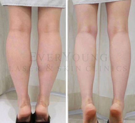 Botox & Calves Slimming Treatment | EverYoung Laser & Skin Clinic