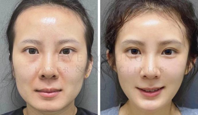 Filler & Botox - Face Slimming | EverYoung Laser & Skin Clinic